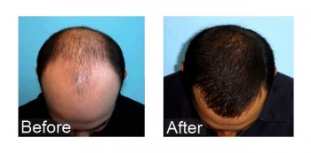 FUE-Hair-Transplant-in-Surat