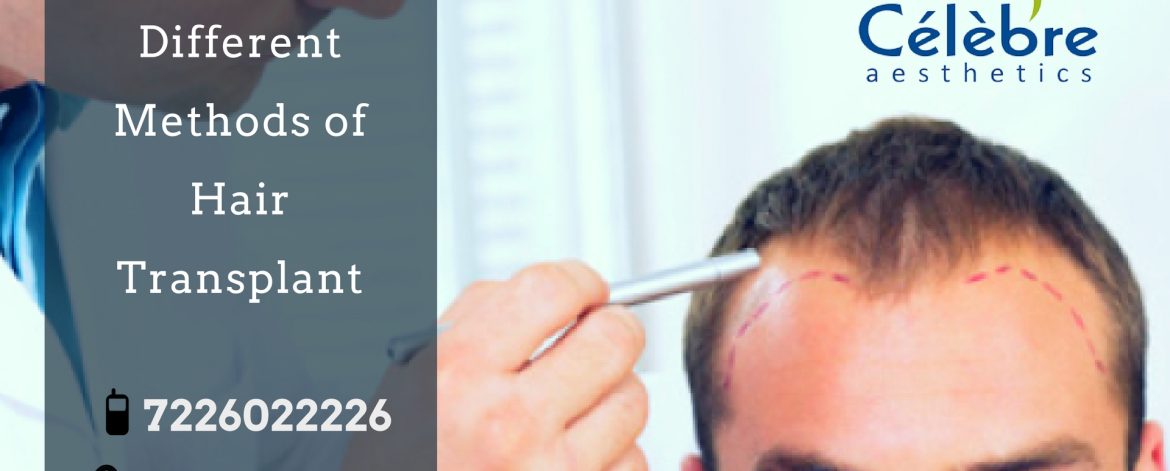 Different-Methods-of-hair-Transplant-1 Different-Methods-of-hair-Transplant-1