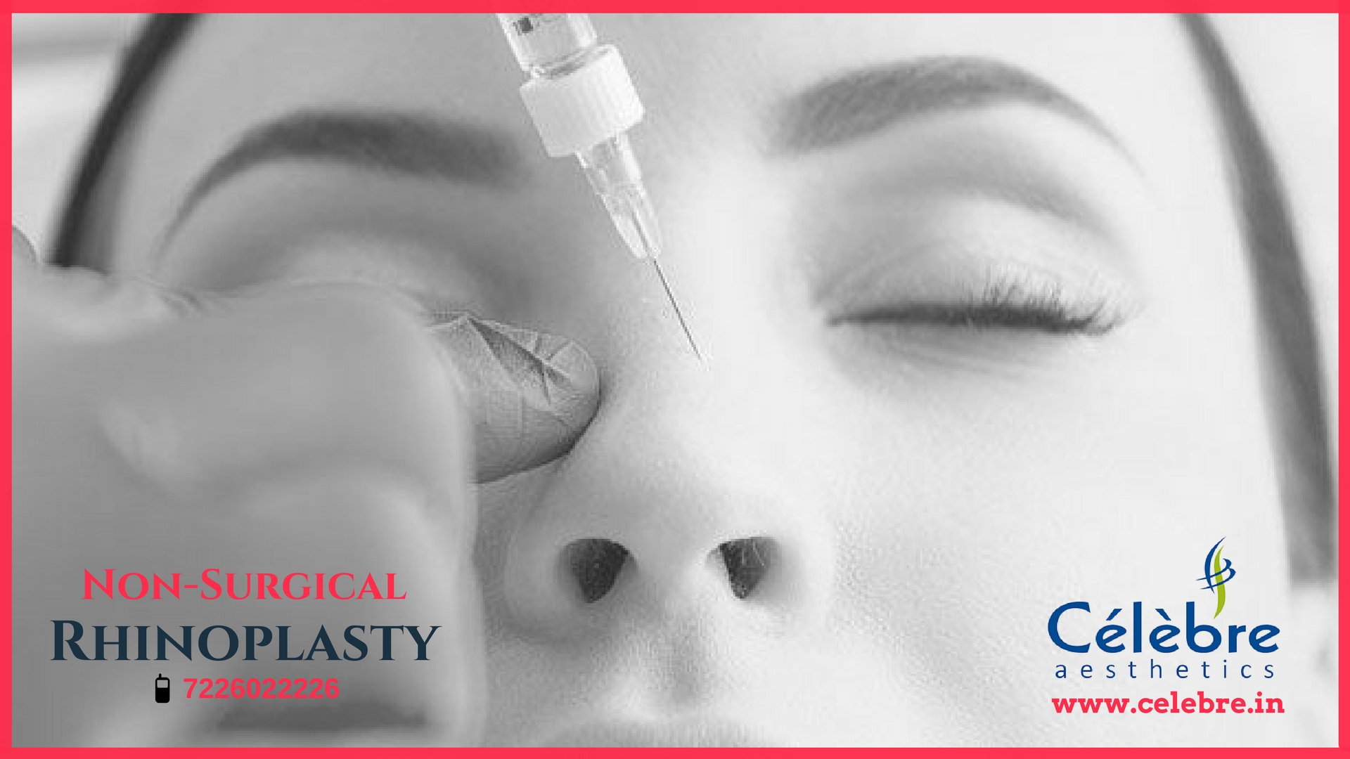 Non Surgical Rhinoplasty in Surat