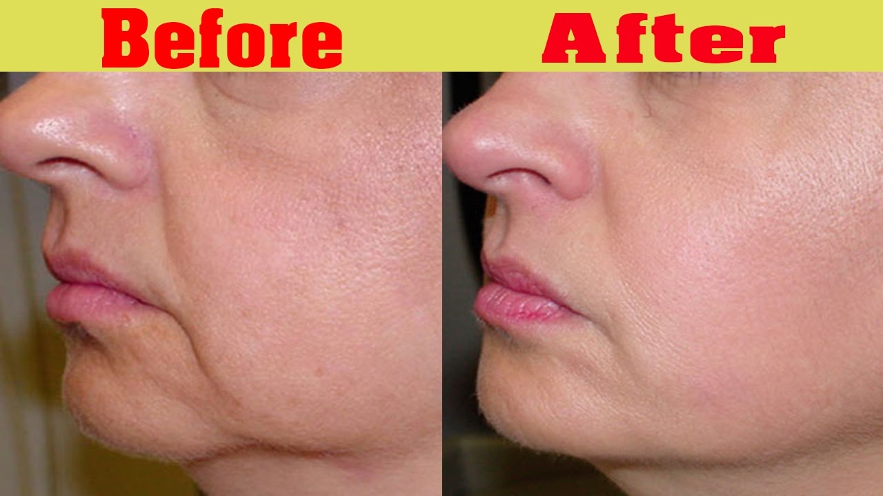 SKIN TIGHTENING TREATMENT