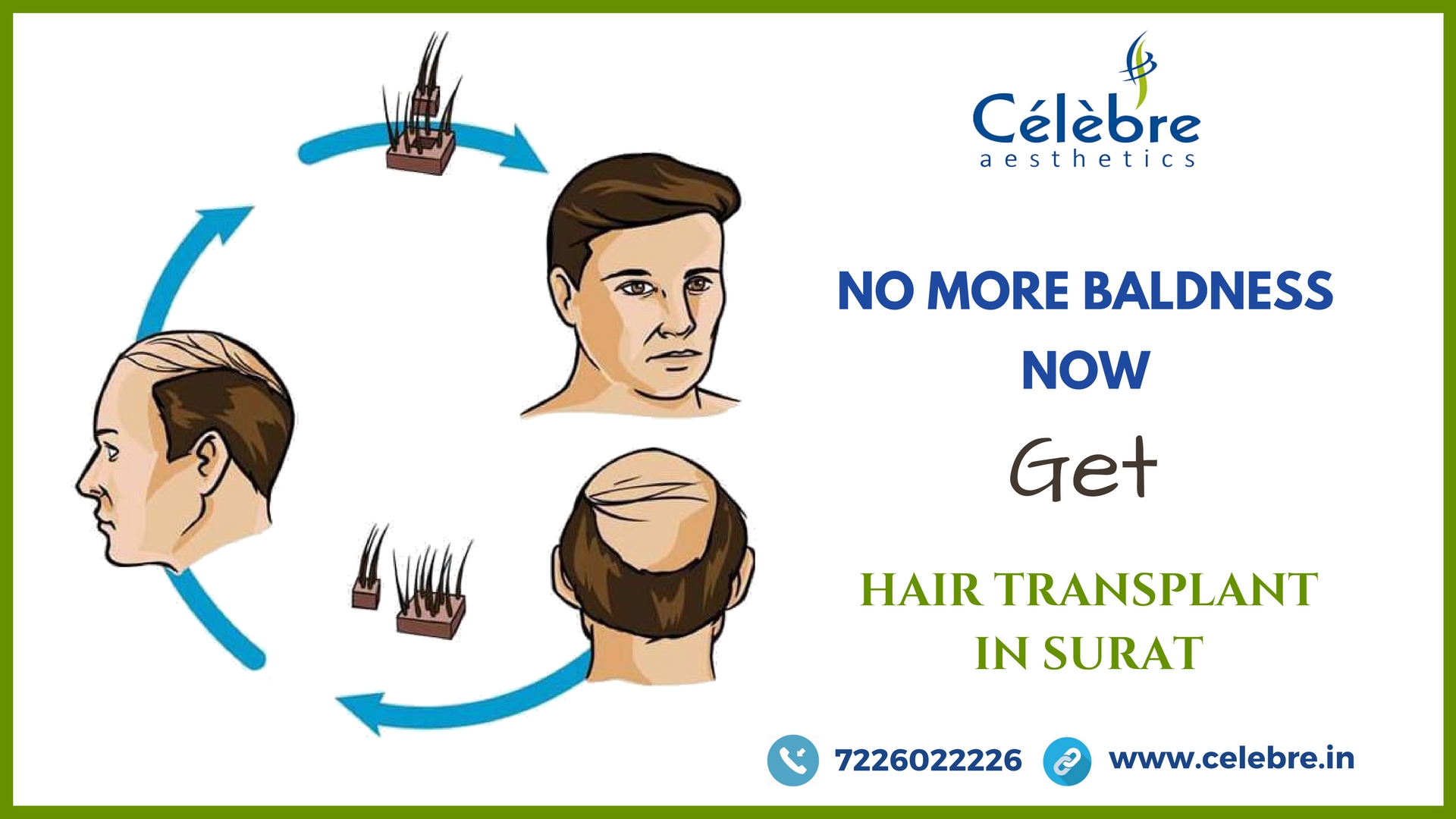 Hair Transplant in Surat