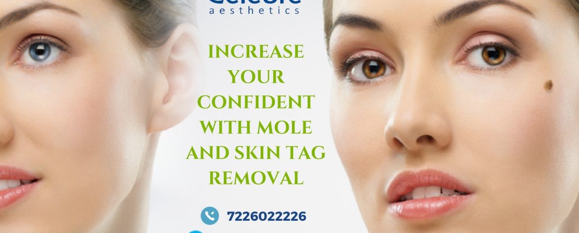 Increase-Your-Confident-With-Mole-and-Skin-Tag-Removal-min Increase-Your-Confident-With-Mole-and-Skin-Tag-Removal-min
