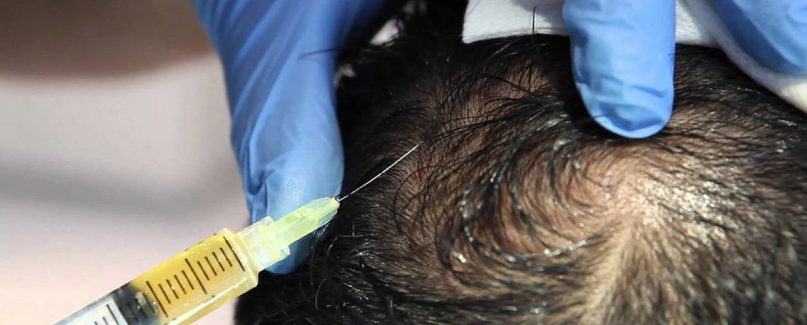 Hair-Mesotherapy-in-Surat Hair-Mesotherapy-in-Surat