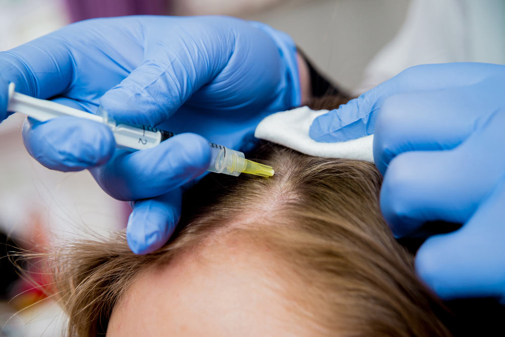 Hair Mesotherapy