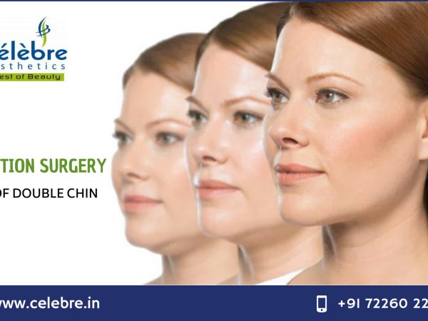 Liposuction-Surgery-in-Surat Liposuction-Surgery-in-Surat