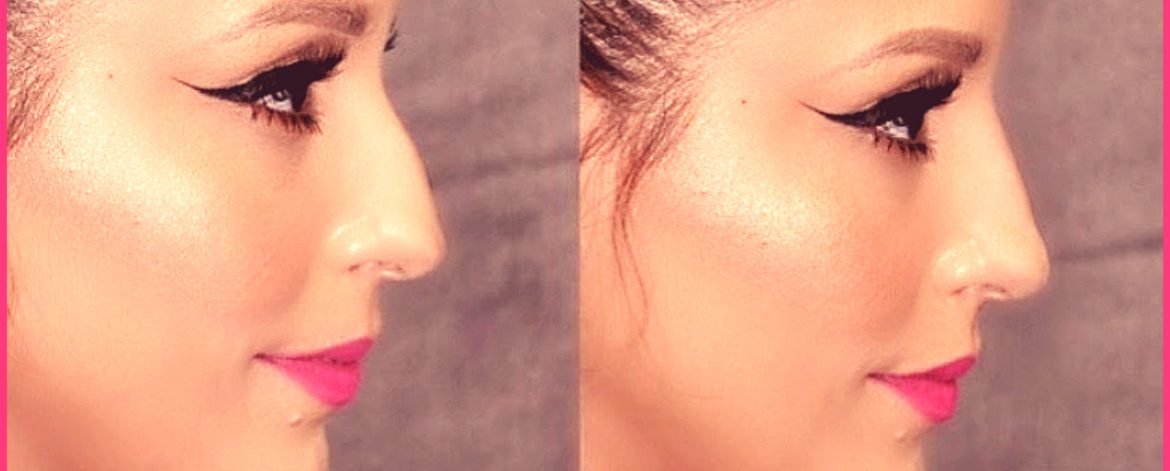 Non-Surgical-Nose-Job-treatment-in-Surat Non-Surgical-Nose-Job-treatment-in-Surat
