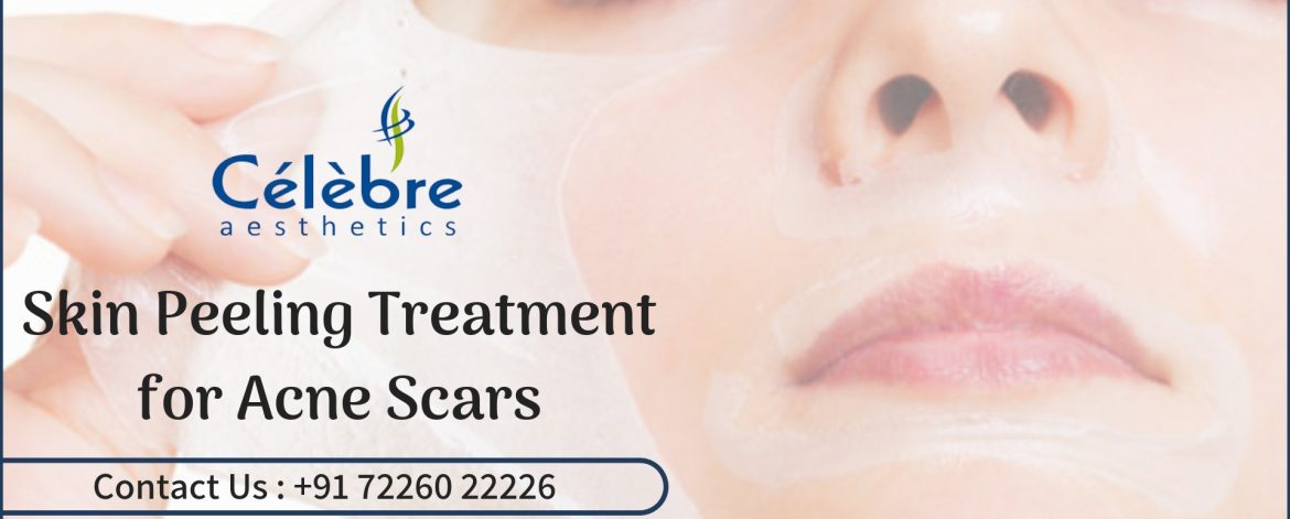 Skin-Peeling-Treatment Skin-Peeling-Treatment