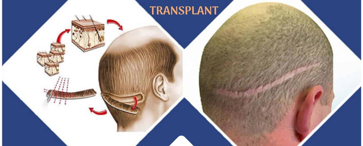 Busting-the-Myths-about-FUT-hair-transplant Busting-the-Myths-about-FUT-hair-transplant