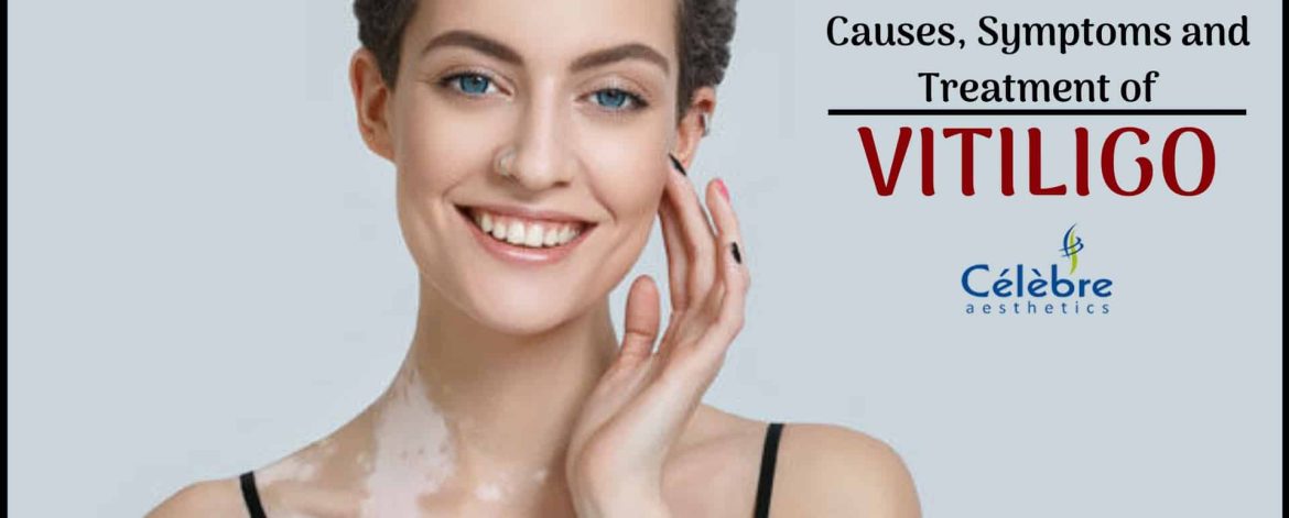Vitiligo-Treatment Vitiligo-Treatment